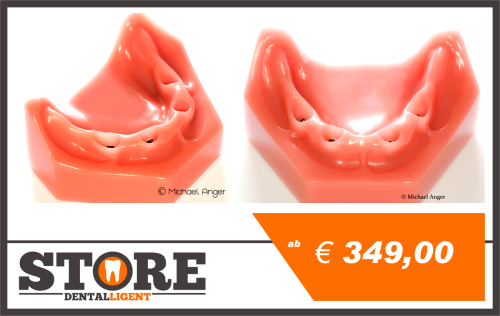 Artikelbild des Artikels “UK-DEMO-Modell Rosa PMMA mit 4 Implantaten “