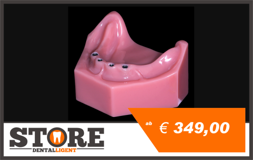 Artikelbild des Artikels “UK Modell mit 4 Implantaten in rosa Acryl ohne Abutments “
