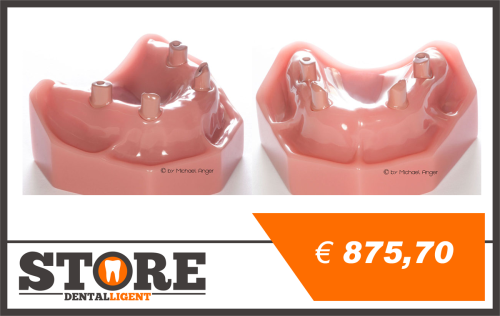 Product image of the product “Upper Jaw with 4 Implants and 4 abutments in Pink PEEK ”