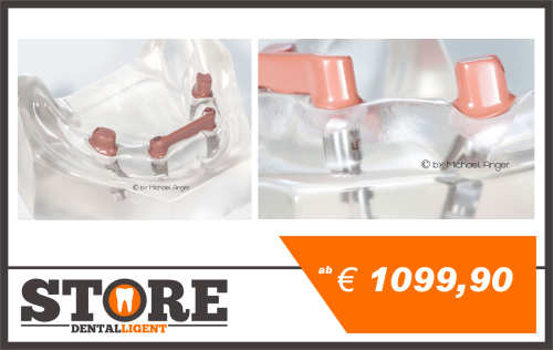 Product image of the product “Lower Jaw with 4 Implants, bar and telescope-abutment in PEEK ”