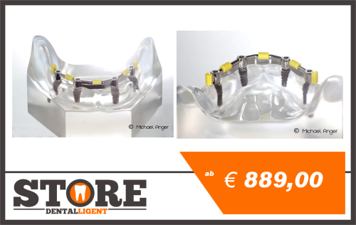 Artikelbild des Artikels “UK Modell klar mit 4 Implantaten und verschraubtem Steg NEM “