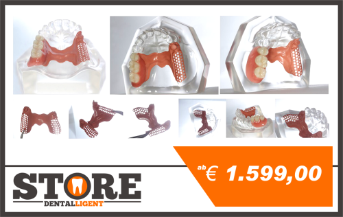 Artikelbild des Artikels “Modell aus klarem Acryl mit PEEK-Modellguss für Geschiebe-Demonstration. Halbseitig fertiggestellt mit Konfektionszähnen. “