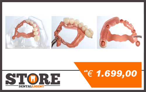 Product image of the product “acrylic model with telescopic bridge from tooth-colored PEEK, one side veneered with composite. ”