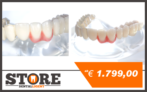 Product image of the product “acrylic model with telescopic bridge from tooth-colored PEEK, one side veneered with composite. ”