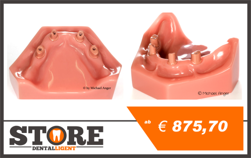 Product image of the product “Lower Jaw model with 4 implants and abutments as telescopes from Pink PEEK. ”