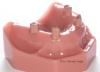 Product image 2 of the product “Upper Jaw with 4 Implants and 4 abutments in Pink PEEK ”