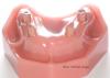 Product image 3 of the product “Upper Jaw with 4 Implants and 4 abutments in Pink PEEK ”