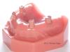 Product image 4 of the product “Upper Jaw with 4 Implants and 4 abutments in Pink PEEK ”