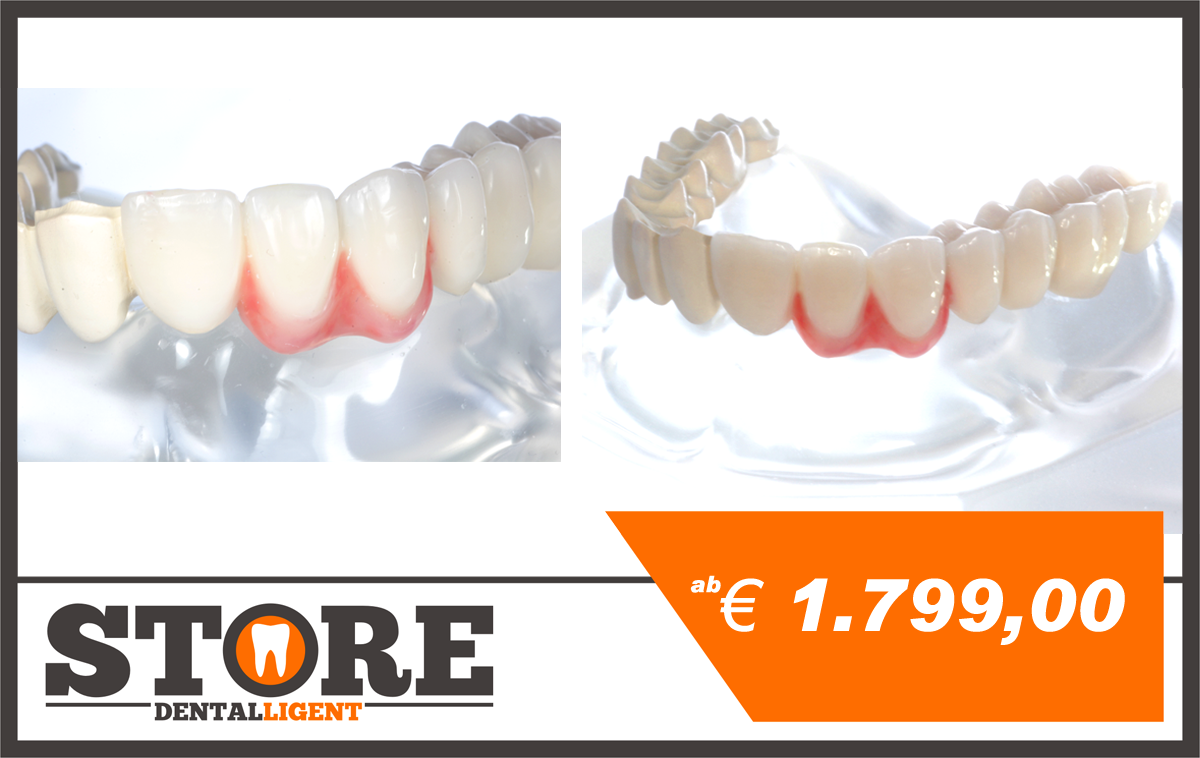 Artikelbild 1 des Artikels “Acryl-Modell mit Teleskopbrücke aus zahnfarbenem PEEK, halbseitig mit Composite verblendet. “