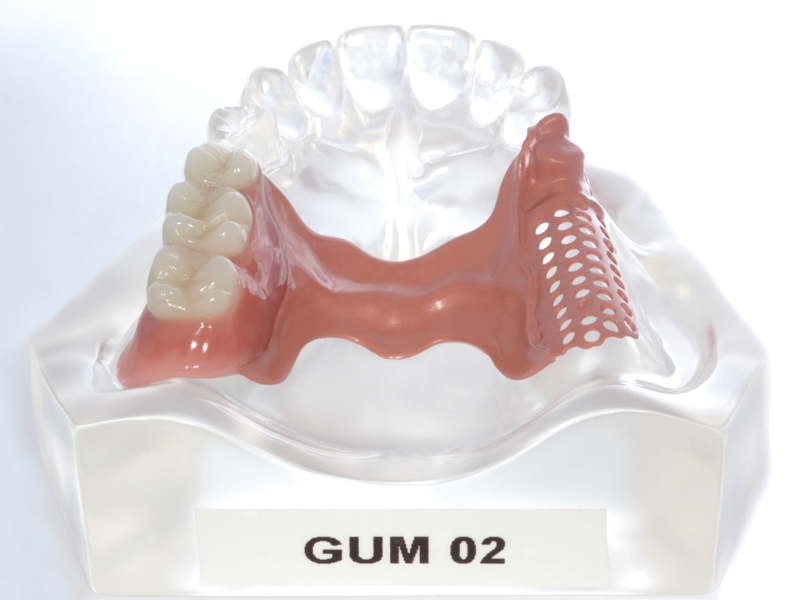 Artikelbild 2 des Artikels “Modell aus klarem Acryl mit PEEK-Modellguss für Geschiebe-Demonstration. Halbseitig fertiggestellt mit Konfektionszähnen. “