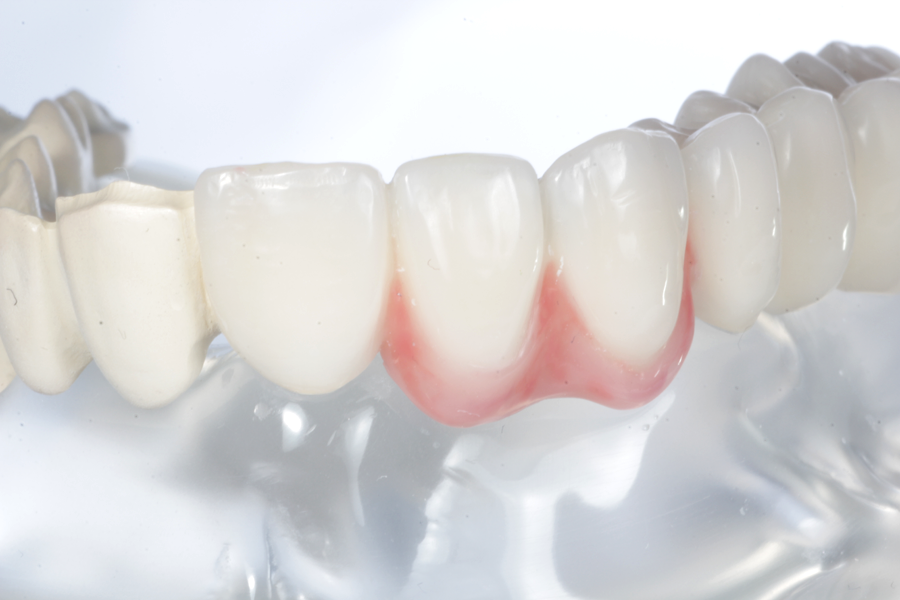 Artikelbild 2 des Artikels “Acryl-Modell mit Teleskopbrücke aus zahnfarbenem PEEK, halbseitig mit Composite verblendet. “