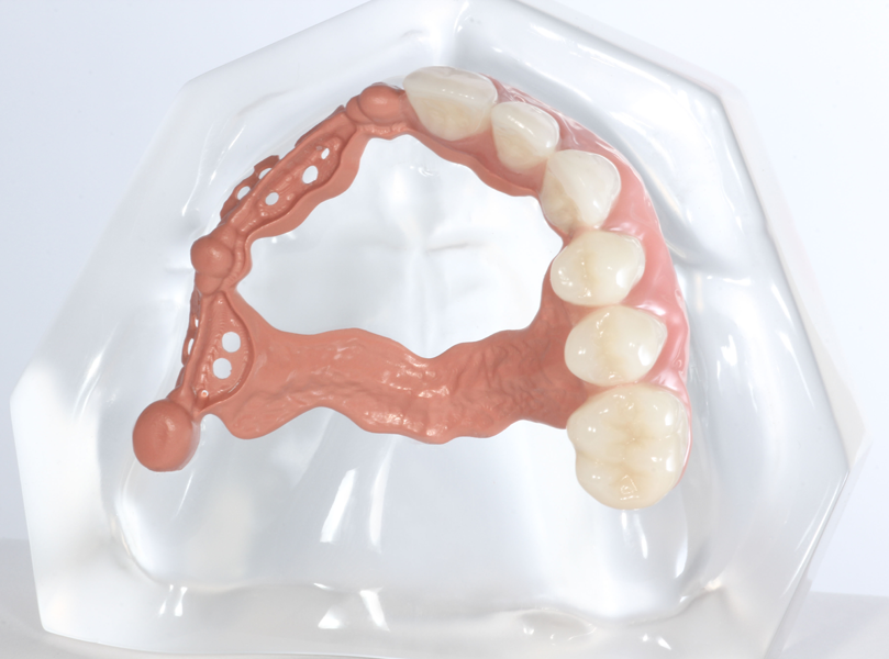 Product image 2 of the product “acrylic model with telescopic bridge from tooth-colored PEEK, one side veneered with composite. ”
