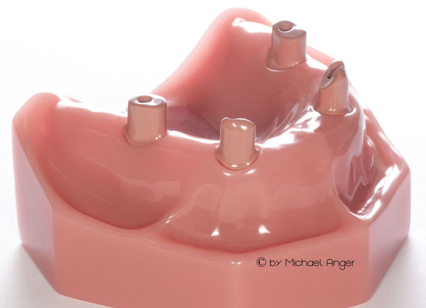 Product image 2 of the product “Upper Jaw with 4 Implants and 4 abutments in Pink PEEK ”