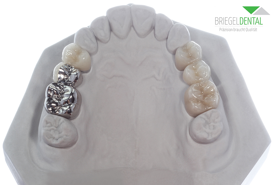 Artikelbild 2 des Artikels “Gipsmodell mit Brücken aus Zirkon und NEM 14-16 & 24-26 keramische Verblendung 4er vollverblendet, 5er vestibulär “