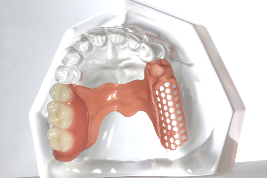 Artikelbild 3 des Artikels “Modell aus klarem Acryl mit PEEK-Modellguss für Geschiebe-Demonstration. Halbseitig fertiggestellt mit Konfektionszähnen. “