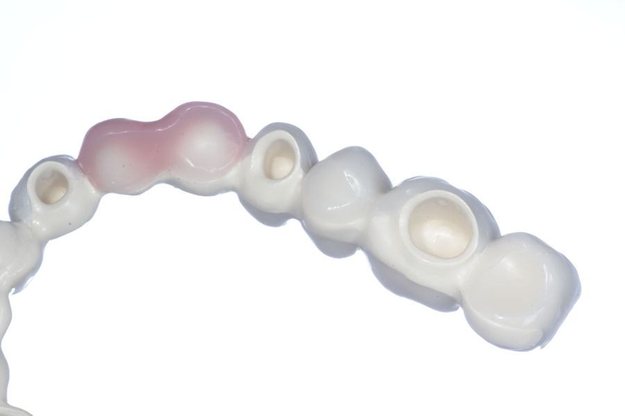 Artikelbild 3 des Artikels “Acryl-Modell mit Teleskopbrücke aus zahnfarbenem PEEK, halbseitig mit Composite verblendet. “