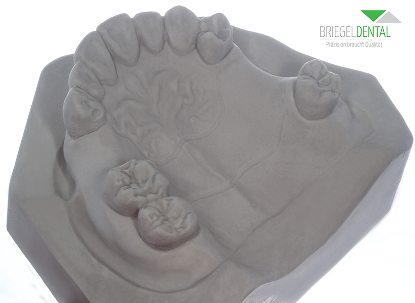 Artikelbild 3 des Artikels “OK-Modell für Modellgussmodellation zum Ersatz 14-15 & 25-26 aus Superhartgips “