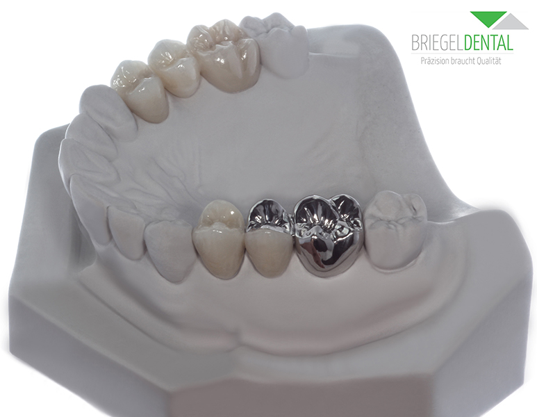 Artikelbild 3 des Artikels “Gipsmodell mit Brücken aus Zirkon und NEM 14-16 & 24-26 keramische Verblendung 4er vollverblendet, 5er vestibulär “