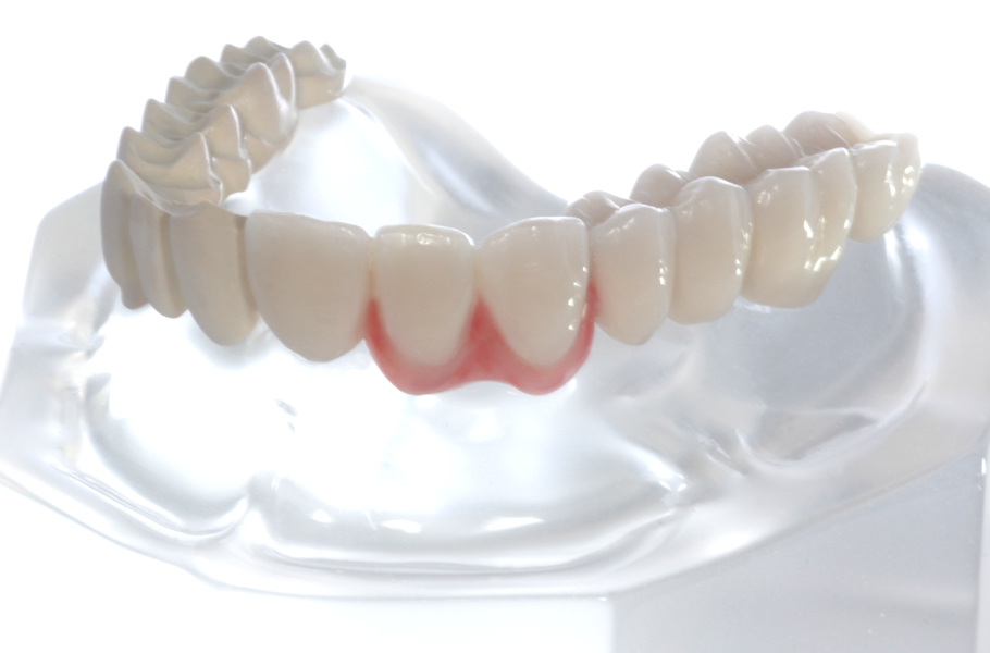 Artikelbild 4 des Artikels “Acryl-Modell mit Teleskopbrücke aus zahnfarbenem PEEK, halbseitig mit Composite verblendet. “